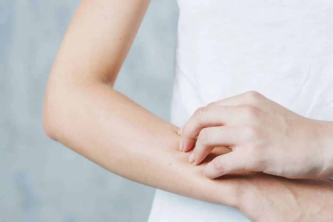  &iquest;Dermatitis at&oacute;pica en verano?: As&iacute; es c&oacute;mo puedes tratarla en casa. Foto freepik. 