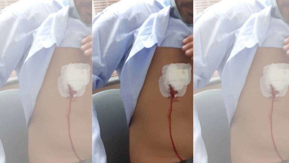 Imagen de las heridas infligidas a la víctima (C.A.) APUÑALAMIENTO MIXTO