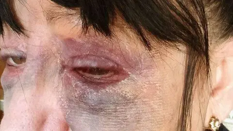 ojo agredida