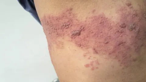 Herpes Z&oacute;ster