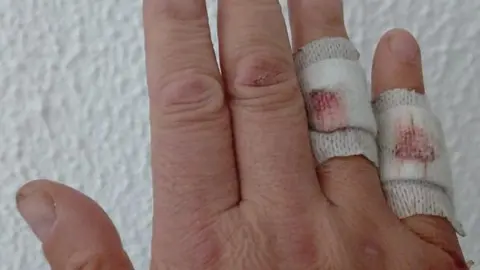 Heridas sufridas por un guardia civil durante el paso de inmigrantes