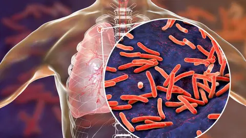 tuberculosis-
